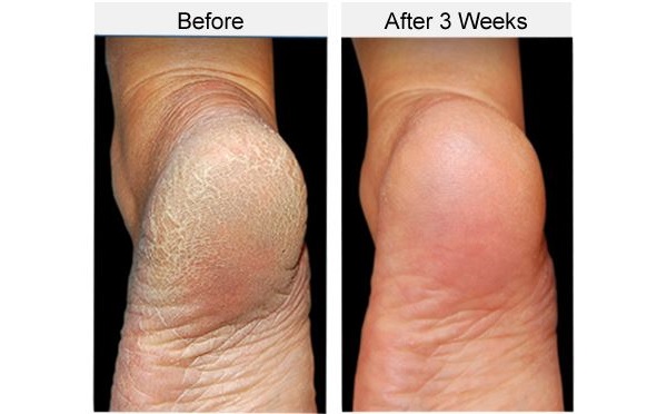 Achieve Beach-Ready Feet at Home With 