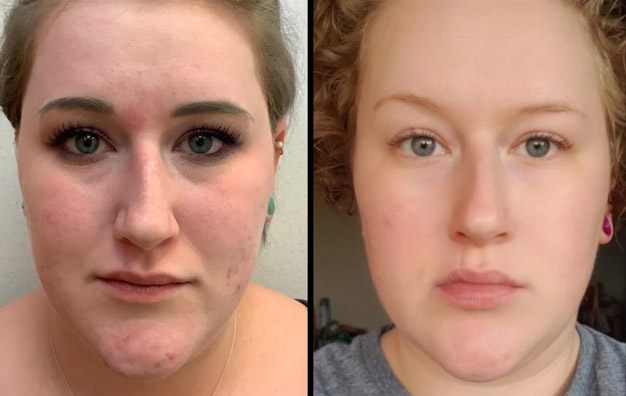 Accutane Before and After Photos. Forward Facing.