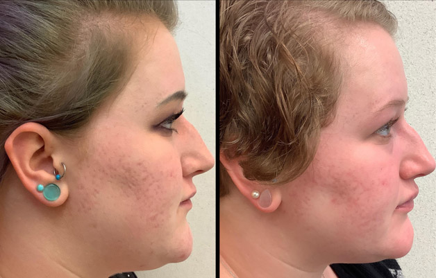 Accutane Before and After Photos. Right Profile.