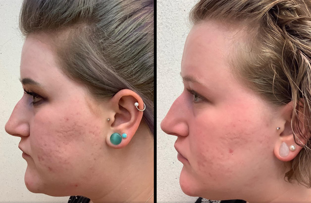 Accutane Before and After Photos. Left Profile.