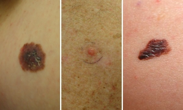 What Is Melanoma How To Tell If A Mole Is Cancerous Lovelyskin